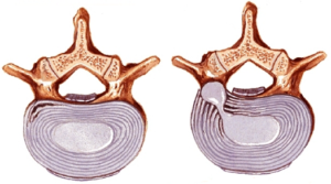 Discus hernia